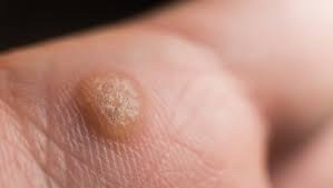 Verruca (plantar wart) close-up showing the characteristic rough, raised appearance